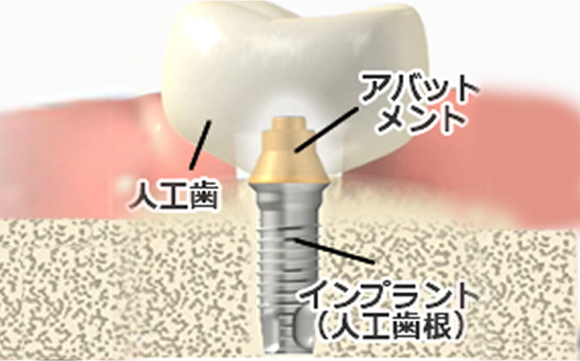 失った歯を人工的に取り戻すインプラント